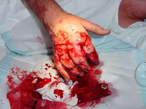 hand-injury4